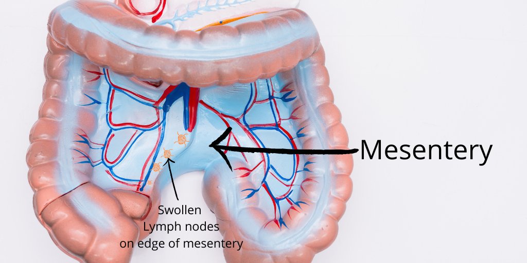 Mesenteric Lymphadenitis Causes Symptoms Diagnosis And Treatment